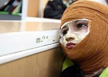 عدم حمایت بیمه‌ها و بخش درمان از بیماران سوانح سوختگی